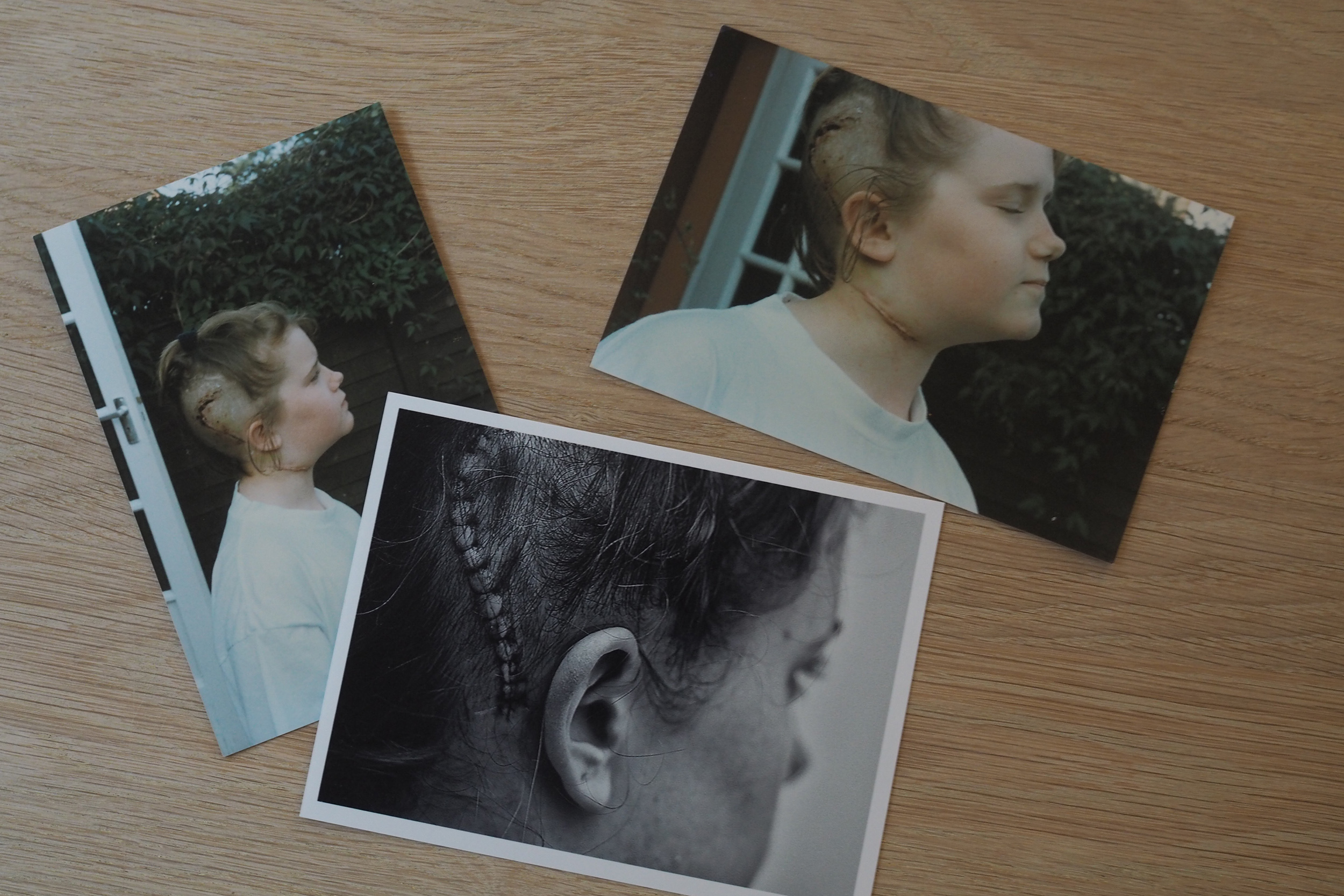 Scars from Shunt surgery. Young Hannah and old Hannah.